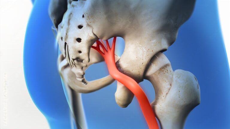 What Do You Need to Know About Sciatica?