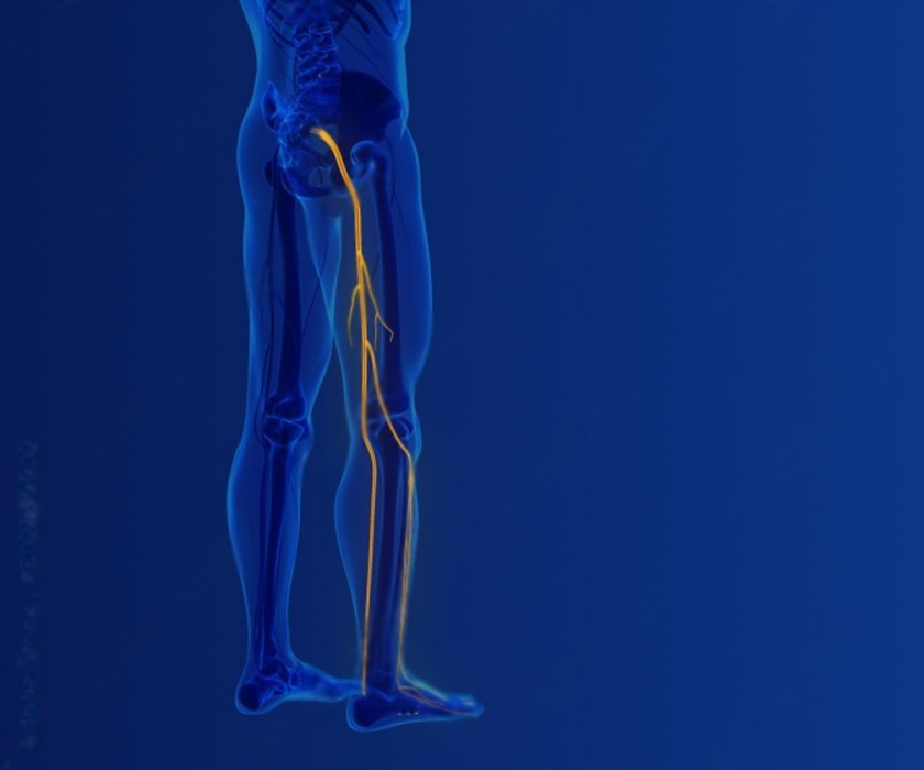 sciatica treatment melbourne