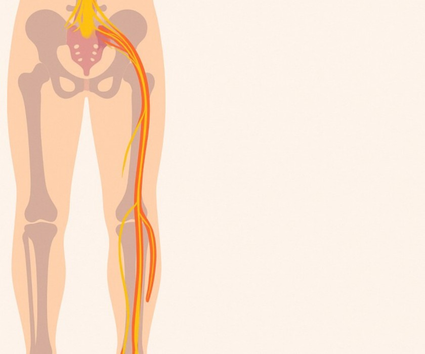 what is sciatica nerve